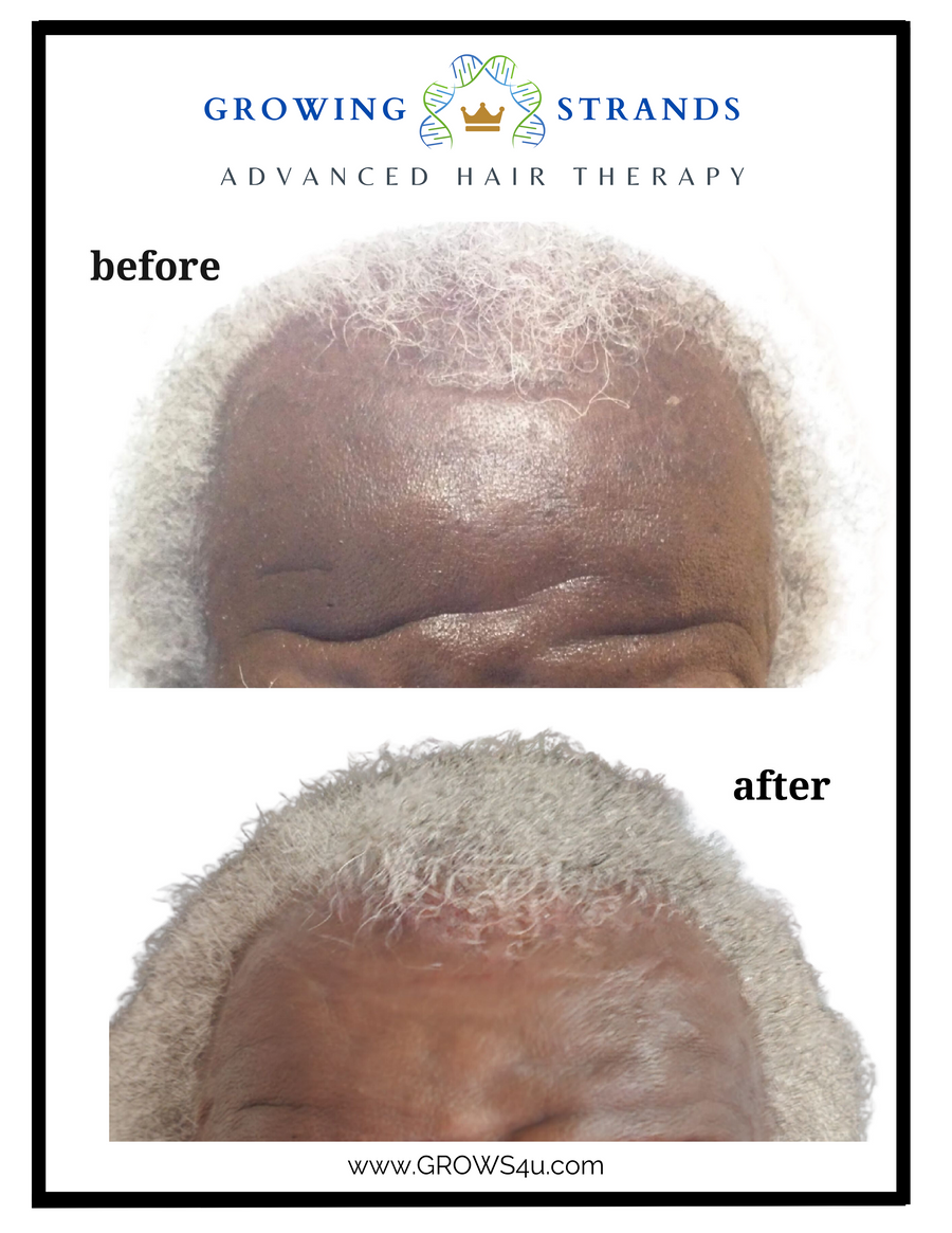 Scalp Spray